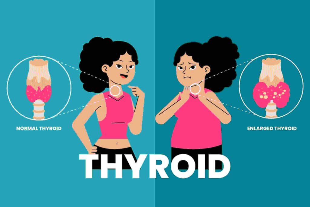 Thyroid dysfunction